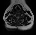 Astrocytoma - spinal cord (Radiopaedia 69769-79758 Axial T2 12).jpg