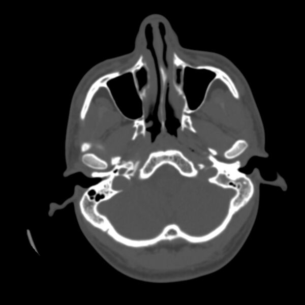 File:Asymptomatic occipital spur (Radiopaedia 87753-104201 Axial bone window 20).jpg