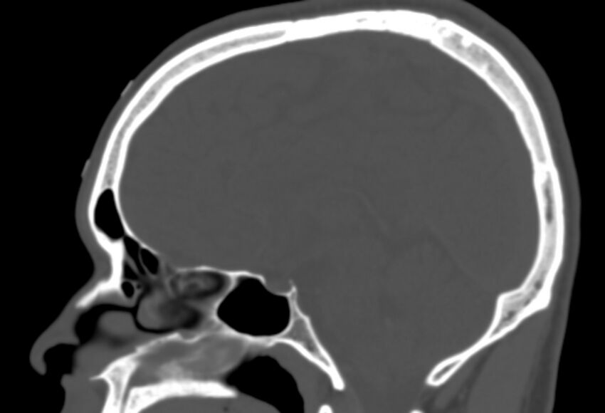 Asymptomatic occipital spur (Radiopaedia 87753-104201 Sagittal bone window 152).jpg