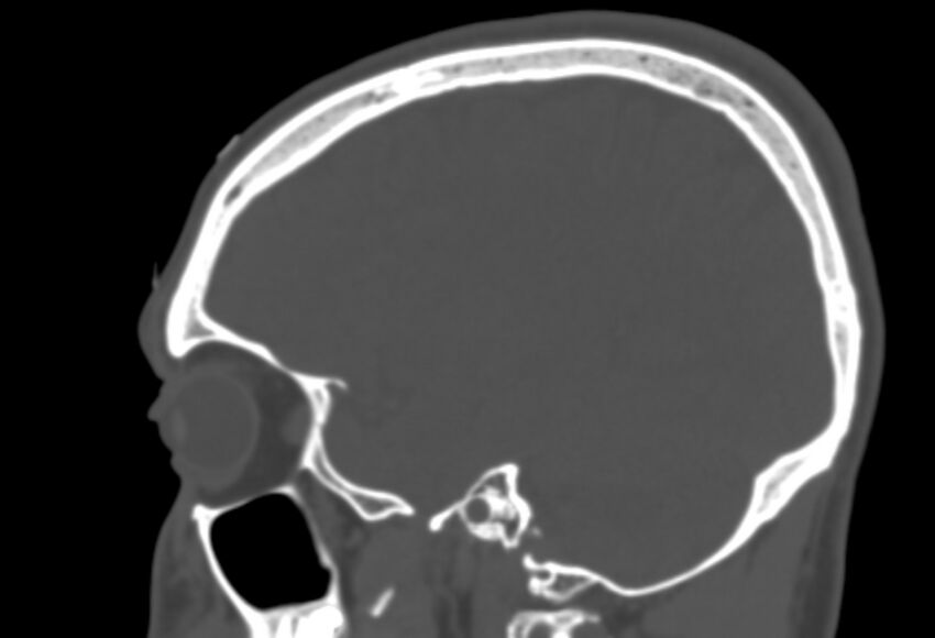 Asymptomatic occipital spur (Radiopaedia 87753-104201 Sagittal bone window 219).jpg