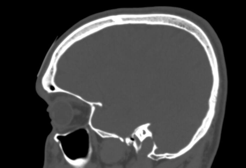 Asymptomatic occipital spur (Radiopaedia 87753-104201 Sagittal bone window 82).jpg