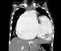 Atrial septal defect complicated by Eisenmenger syndrome (Radiopaedia 53707-59768 Coronal C+ CTPA 7).jpg