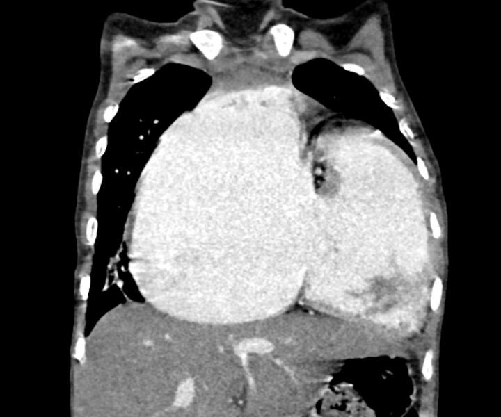 File:Atrial septal defect complicated by Eisenmenger syndrome (Radiopaedia 53707-59768 Coronal C+ CTPA 7).jpg
