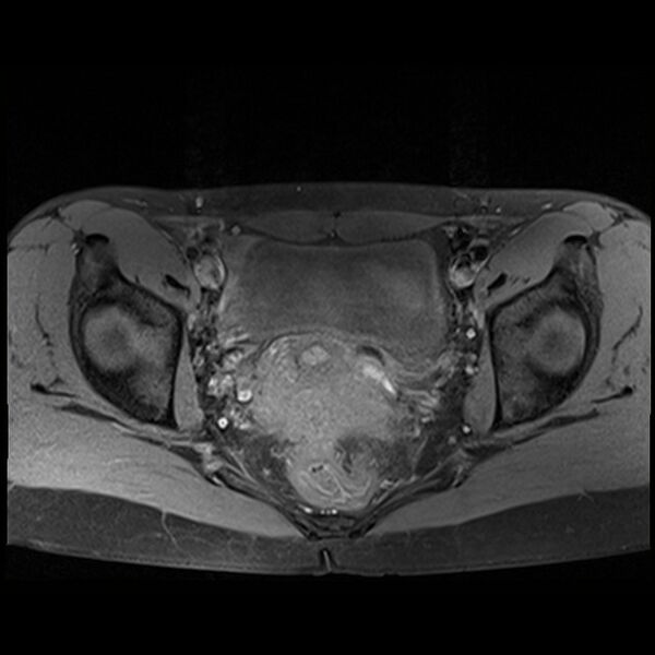 File:Atypical deep infiltrating endometriosis (Radiopaedia 44470-48125 Axial T1 fat sat 18).jpg