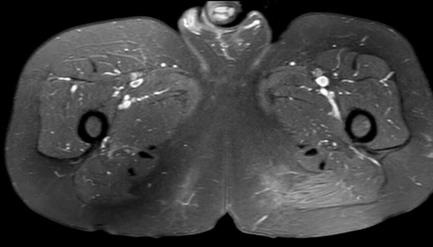 Atypical lipomatous tumor - thigh (Radiopaedia 68975-78734 Axial PD fat sat 73).jpg
