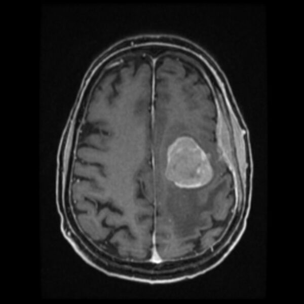File:Atypical meningioma (Radiopaedia 45535-49629 Axial T1 C+ 49).jpg
