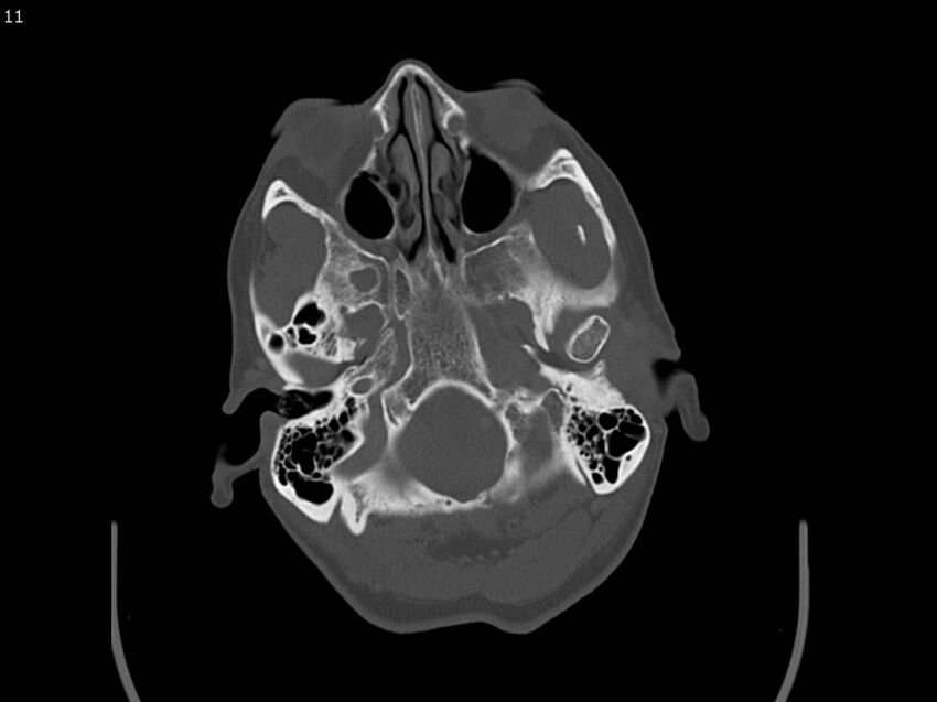 Atypical meningioma - intraosseous (Radiopaedia 64915-73867 Axial C+ bone window 11).jpg