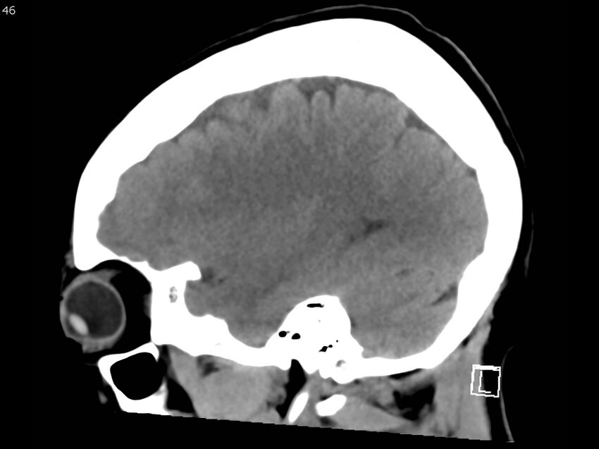 Atypical meningioma - intraosseous (Radiopaedia 64915-73867 C 44).jpg