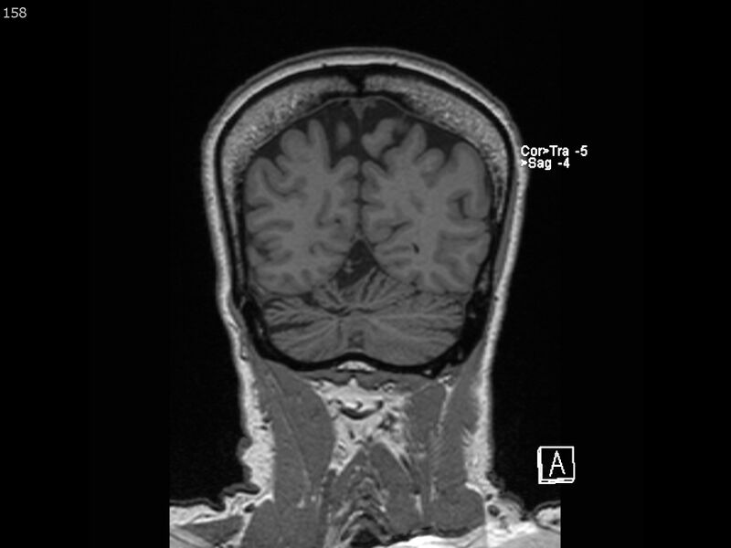 File:Atypical meningioma - intraosseous (Radiopaedia 64915-74572 Coronal T1 158).jpg