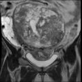 Atypical retroperitoneal lymphocoeles with large leiomyoma of uterus (Radiopaedia 32084-33027 Coronal T2 14).jpg