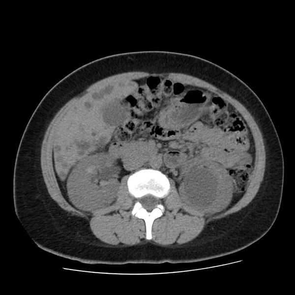 File:Autosomal dominant polycystic kidney disease (Radiopaedia 23061-23093 Axial non-contrast 29).jpg