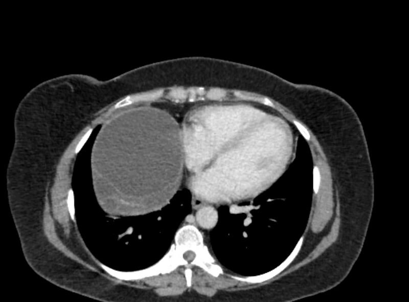 File:Autosomal dominant polycystic kidney disease (Radiopaedia 57124-64017 A 10).jpg