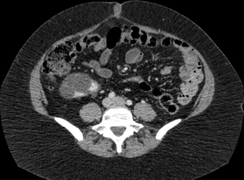 File:Autosomal dominant polycystic kidney disease (Radiopaedia 57124-64017 A 74).jpg