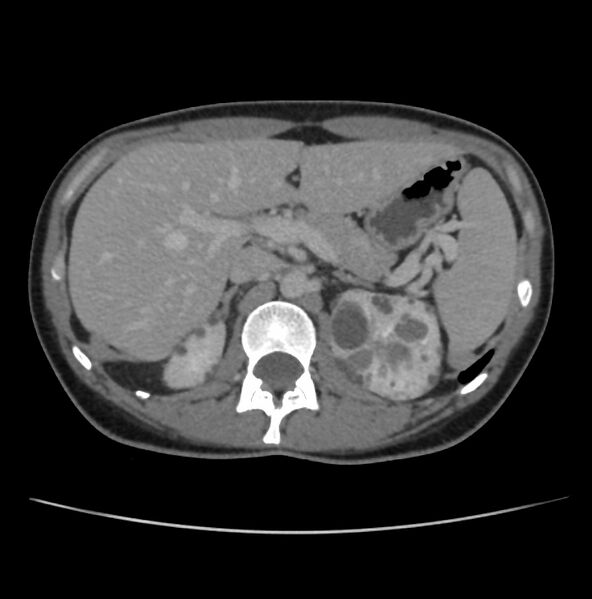 File:Autosomal dominant polycystic kidney disease - early onset (Radiopaedia 40734-43387 A 16).jpg