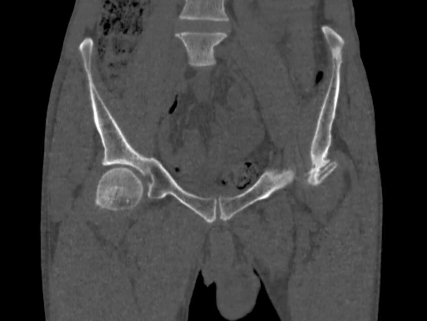 Avascular necrosis of the left hip (Radiopaedia 75068-86125 Coronal bone window 3).jpg