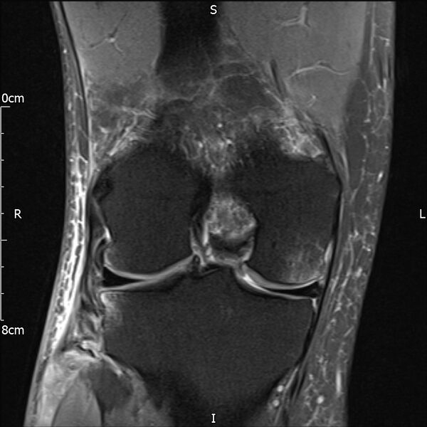 File:Avulsion fracture of the fibular head (Radiopaedia 74804-85808 Coronal PD fat sat 23).jpg