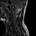 Axis fracture - MRI (Radiopaedia 71925-82375 Sagittal T2 7).jpg