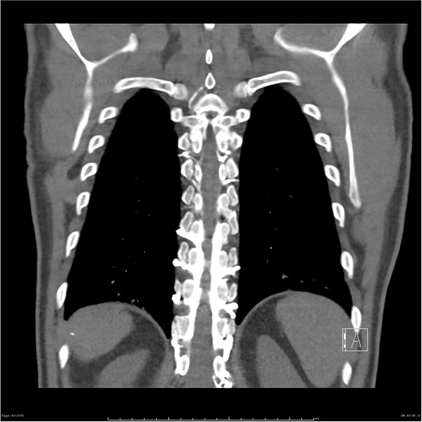 Azygos venous system anatomy (CT pulmonary angiography) (Radiopaedia 25928-26077 Coronal C+ CTPA 64).jpg