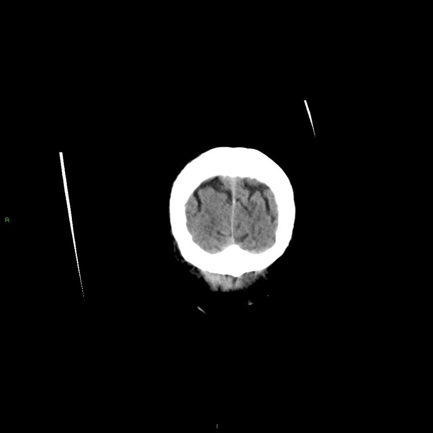Basal ganglia hemorrhage (Radiopaedia 58350-65473 Coronal non-contrast 8).jpg