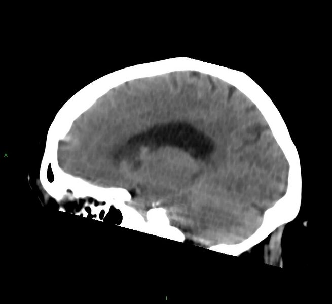 File:Basal ganglia hemorrhage (Radiopaedia 58759-65981 C 33).jpg