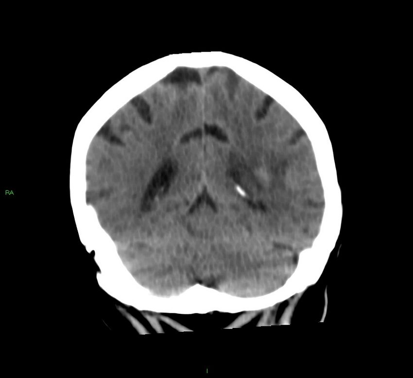Basal ganglia hemorrhage (Radiopaedia 58790-66024 Coronal non-contrast 18).jpg