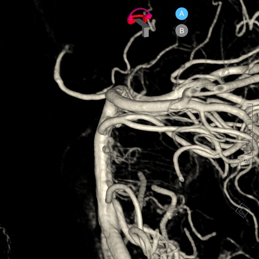 Basilar artery perforator aneurysm (Radiopaedia 82455-97734 3D view left VA 92).jpg
