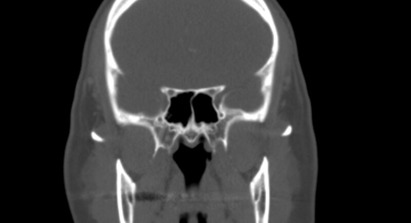 File:Benign mixed salivary tumor of the parotid gland (Radiopaedia 35261-36792 Coronal bone window 12).jpg