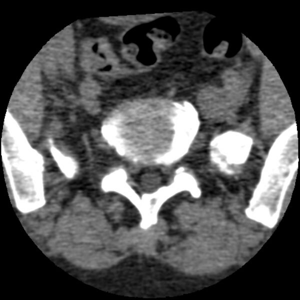 File:Bertolotti syndrome (Radiopaedia 24864-25128 Axial non-contrast 15).jpg