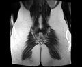 Bicornuate bicollis uterus (Radiopaedia 61626-69616 Coronal T2 33).jpg