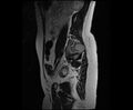 Bicornuate bicollis uterus (Radiopaedia 61626-69616 Sagittal T2 32).jpg