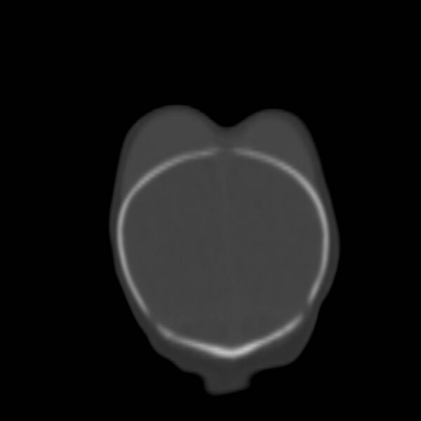 File:Bilateral cephalohematomas and subdural hematomas (Radiopaedia 26778-26929 Coronal bone window 31).jpg