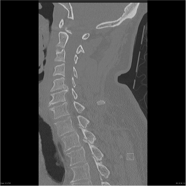 File:Bilateral cervical ribs (Radiopaedia 25868-26017 Sagittal bone window 41).jpg