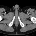 Bilateral direct inguinal herniae (Radiopaedia 17016-16719 B 30).jpg
