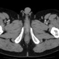 Bilateral direct inguinal herniae (Radiopaedia 17016-16719 B 31).jpg