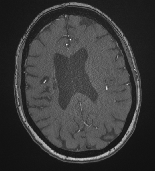 File:Bilateral fetal posterior communicating arteries (Radiopaedia 41286-44102 Axial MRA 142).png