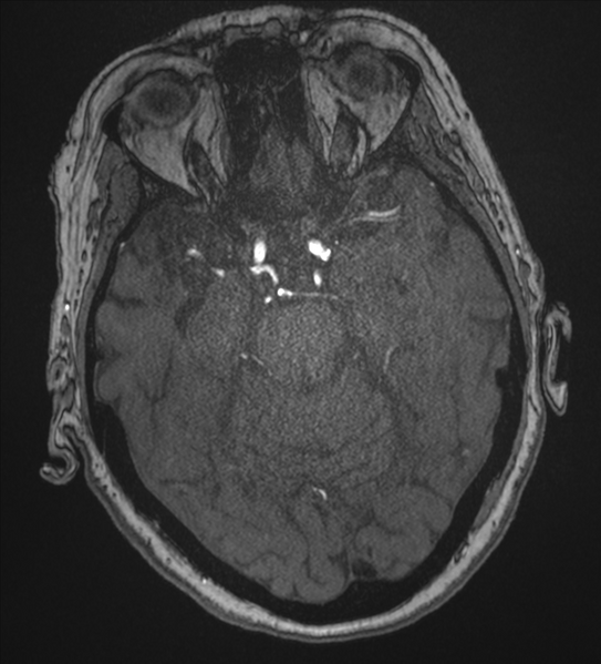 File:Bilateral fetal posterior communicating arteries (Radiopaedia 41286-44102 Axial MRA 72).png