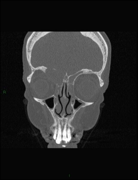File:Bilateral frontal mucoceles (Radiopaedia 82352-96454 Coronal 104).jpg