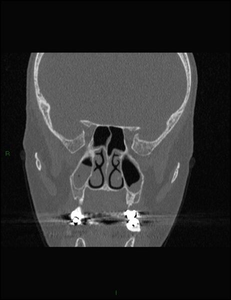 File:Bilateral frontal mucoceles (Radiopaedia 82352-96454 Coronal 184).jpg