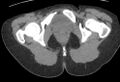 Bilateral mature cystic ovarian teratoma (Radiopaedia 88821-105592 Axial non-contrast 58).jpg