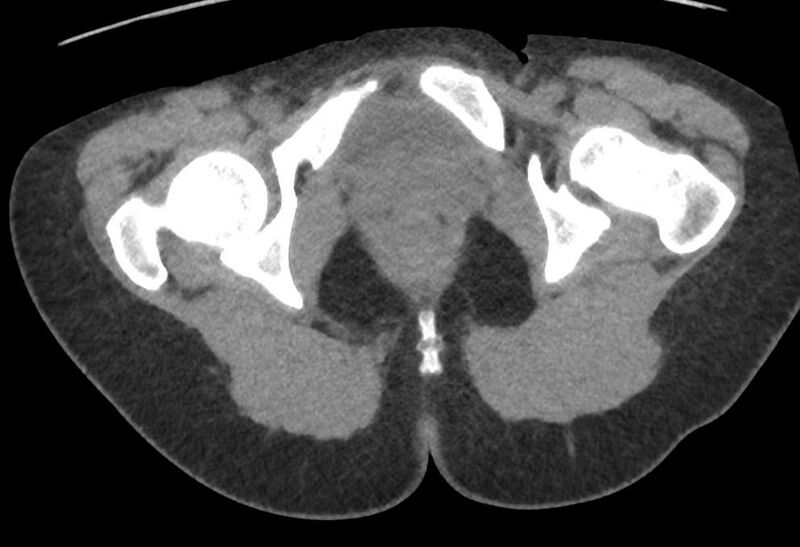 File:Bilateral mature cystic ovarian teratoma (Radiopaedia 88821-105592 Axial non-contrast 58).jpg
