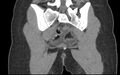 Bilateral mature cystic ovarian teratoma (Radiopaedia 88821-105592 Coronal non-contrast 32).jpg
