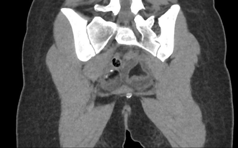 File:Bilateral mature cystic ovarian teratoma (Radiopaedia 88821-105592 Coronal non-contrast 32).jpg