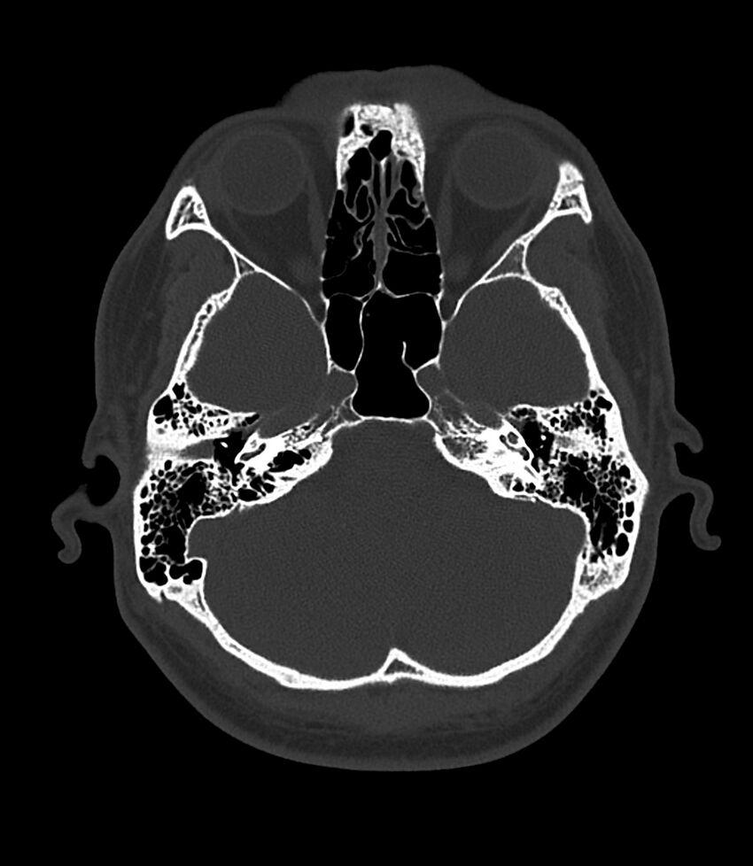 Bilateral medial canal fibrosis (Radiopaedia 85598-101344 Axial bone window 38).jpg