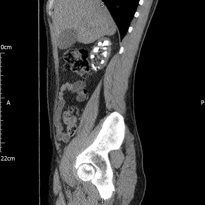 Bilateral medullary nephrocalcinosis with ureteric calculi (Radiopaedia 71269-81569 C 81).jpg