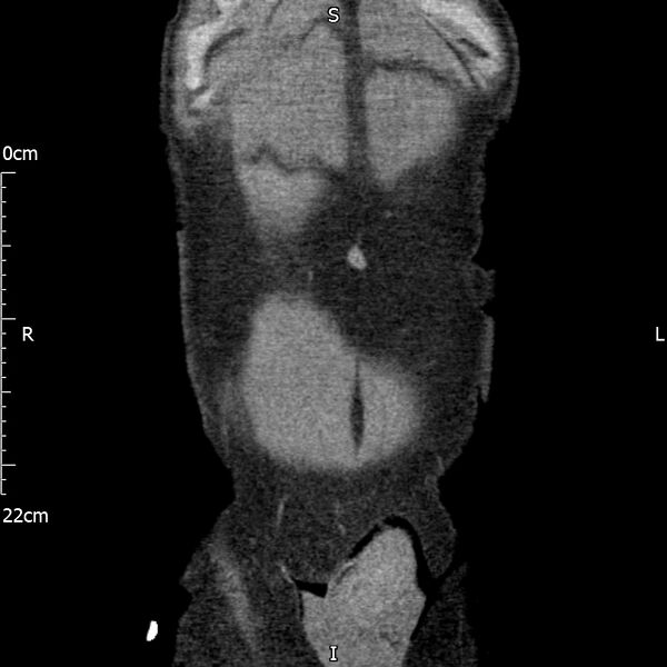 File:Bilateral medullary nephrocalcinosis with ureteric calculi (Radiopaedia 71269-81569 Coronal non-contrast 9).jpg