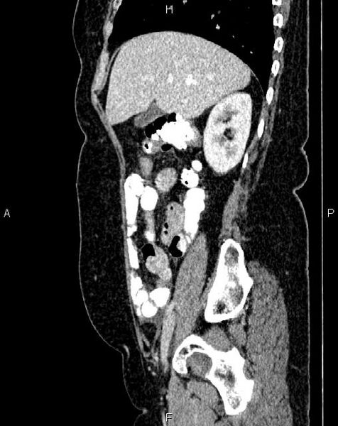 File:Bilateral ovarian serous cystadenocarcinoma (Radiopaedia 86062-101989 E 21).jpg
