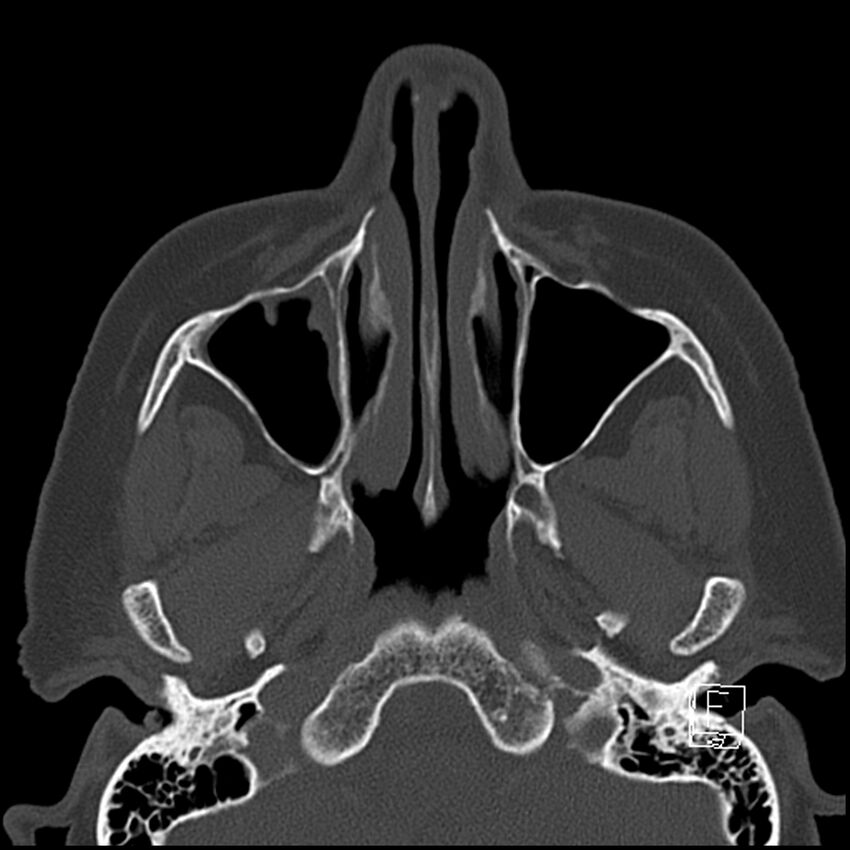 Bilateral palatine tonsilloliths on OPG and CT (Radiopaedia 75167-86247 Axial bone window 22).jpg