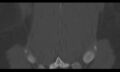 Bilateral pars defect (Radiopaedia 26691-26846 Coronal bone window 45).jpg