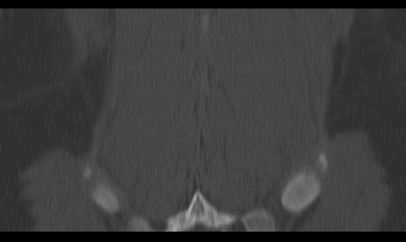 File:Bilateral pars defect (Radiopaedia 26691-26846 Coronal bone window 45).jpg
