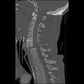 Bilateral perched facets with cord injury (Radiopaedia 45587-49713 Sagittal bone window 27).jpg